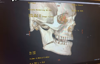 Eddie Alvarez Reveals Horrifying Broken Jaw X-Ray Following BKFC: KnuckleMania 5 Loss