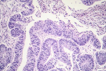 Some Cancer Genes Could Play A Role In Protecting You